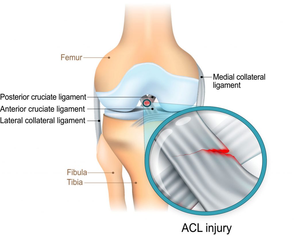 Knee ligament anatomy diagram showing the ACL, MCL and LCL knee ligament. Shown is a tear ACL.