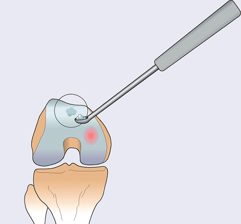 A tiny specimen is arthroscopically collected above the area showing degeneration of cartilage in the knee. 