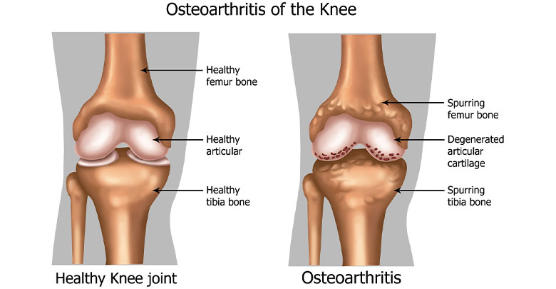 Anatomy of the knee joint showing a healthy knee joint compared to a osteoarthritis knee joint.