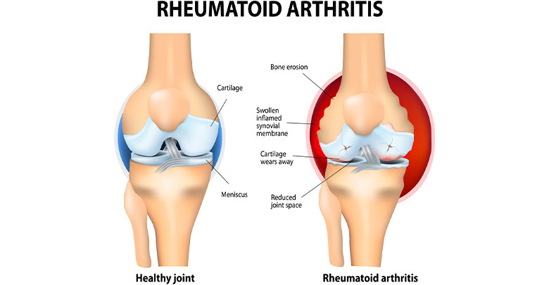 Anatomy of the knee joint comparing a healthy knee and a rheumatoid arthritis knee joint.