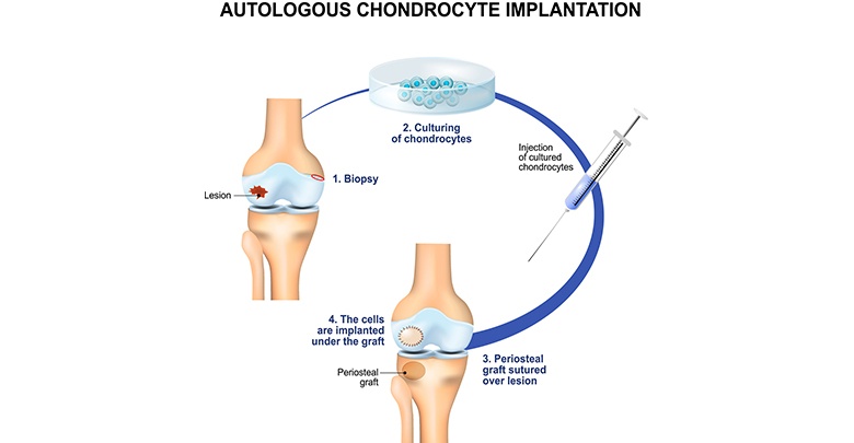 The final step in the treatment of degeneration of cartilage in the knee using tissue engineering