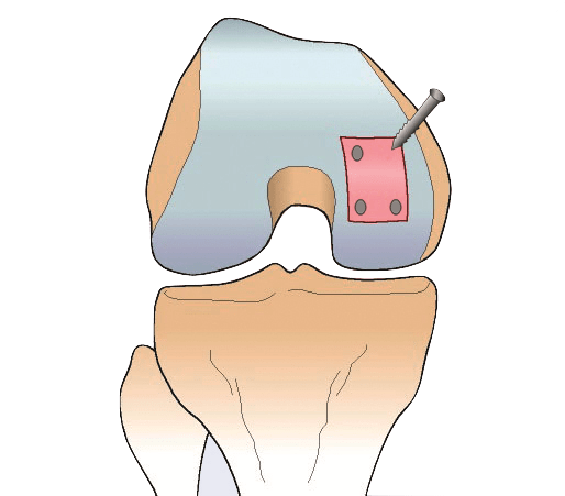 Membrane-cell structure is implanted for the treatment of a degeneration of cartilage in the knee 