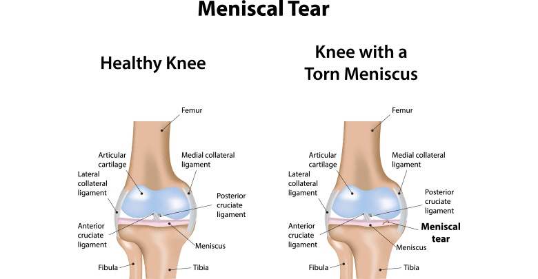 This image shows the anatomy of the parts of the knee. It also shows a normal healthy knee, and a torn knee meniscus in the other image. 