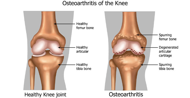 Osteoarthritis diagnosis is made based on the clinical findings - here you can see an image of a normal knee, and one with a diagnosis of osteoarthritis. 