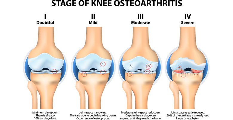 Following a diagnosis of osteoarthritis, the disease gradually progresses as shown here in this image showing stages 1 - 4.