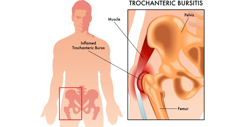 bursitis of the hip is inflammation of the bursa