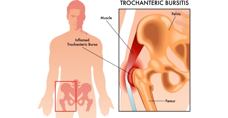 bursitis of the hip is inflammation  of the bursa 